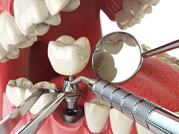 Best Emergency Broken Tooth Repair in Wenatchee, WA